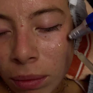 Limpieza Facial con Dermapen y Fototerapia LED