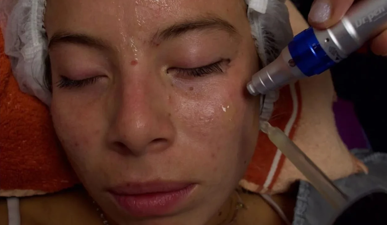 Limpieza Facial con Dermapen y Fototerapia LED
